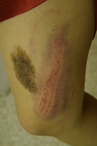 Rugby Thigh Bruise